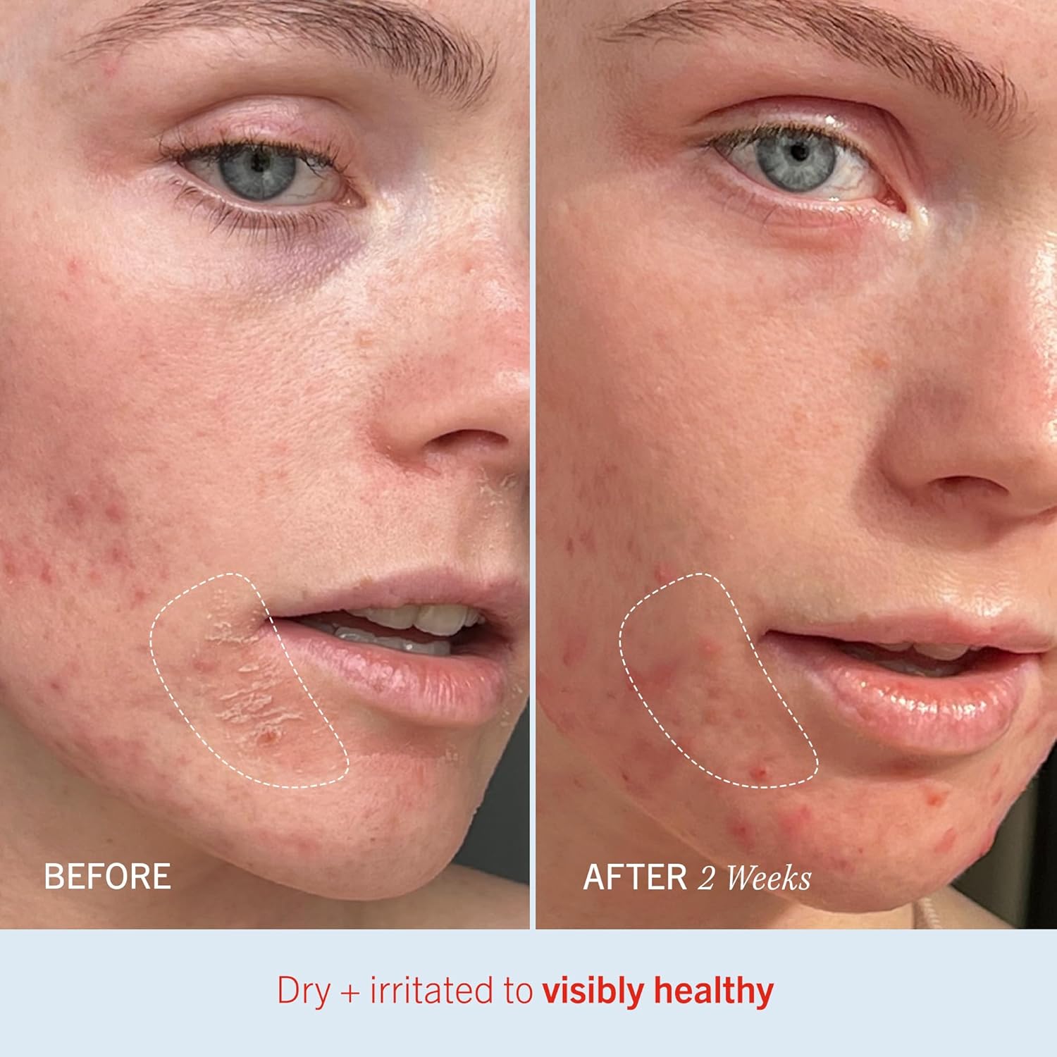 Best Sunscreen for Sensitive Skin in 2025